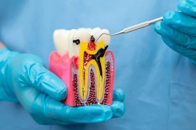Root Canal Treatment in Greater Noida