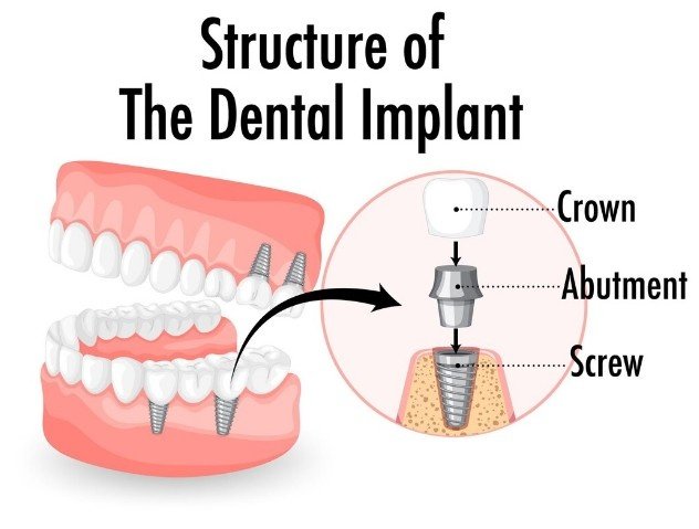 Best Clinic for Dental Implants in Greater Noida
