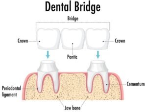 Dental Crowns and Bridges treatment in Greater Noida