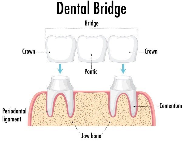 Dental Crowns and Bridges treatment in Greater Noida