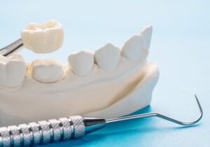 Dental Crowns & Bridges Treatment in Greater Noida