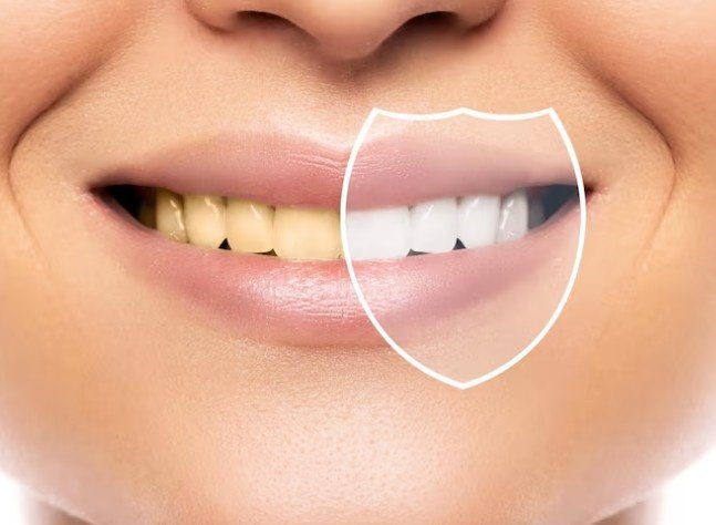 Teeth Whitening clinic in Greater Noida