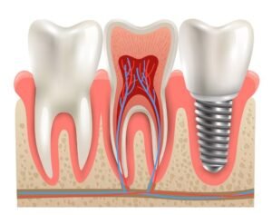 Dental Implant Center in Greater Noida
