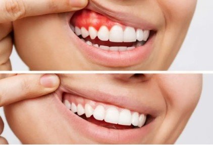 Best Gum Disease Treatment in Greater Noida