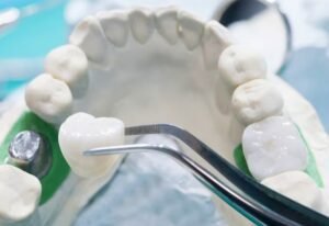 Best Crowns and Bridges Treatment in Greater Noida