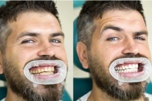 Best Teeth Whitening Dentist in Greater Noida