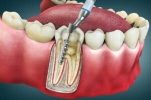 Best Root Canal Dentist in Greater Noida
