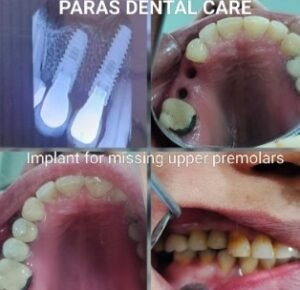 Dental Implant care clinic in Greater Noida