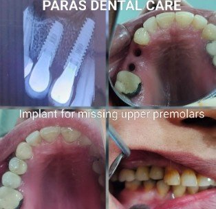 Dental Implant care clinic in Greater Noida