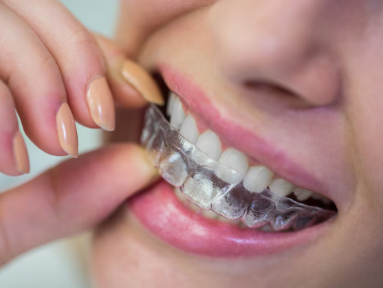 Best Dental Clinic for Invisible Braces in Greater Noida