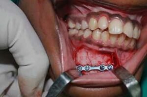 Facial Fracture Treatment in Techzone 4