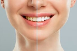Best Teeth Whitening Clinic in Techzone 4,
