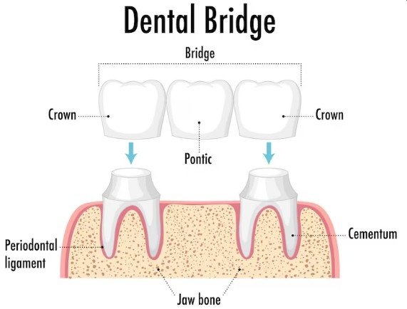 Dental Crowns and Bridges in Noida Extension